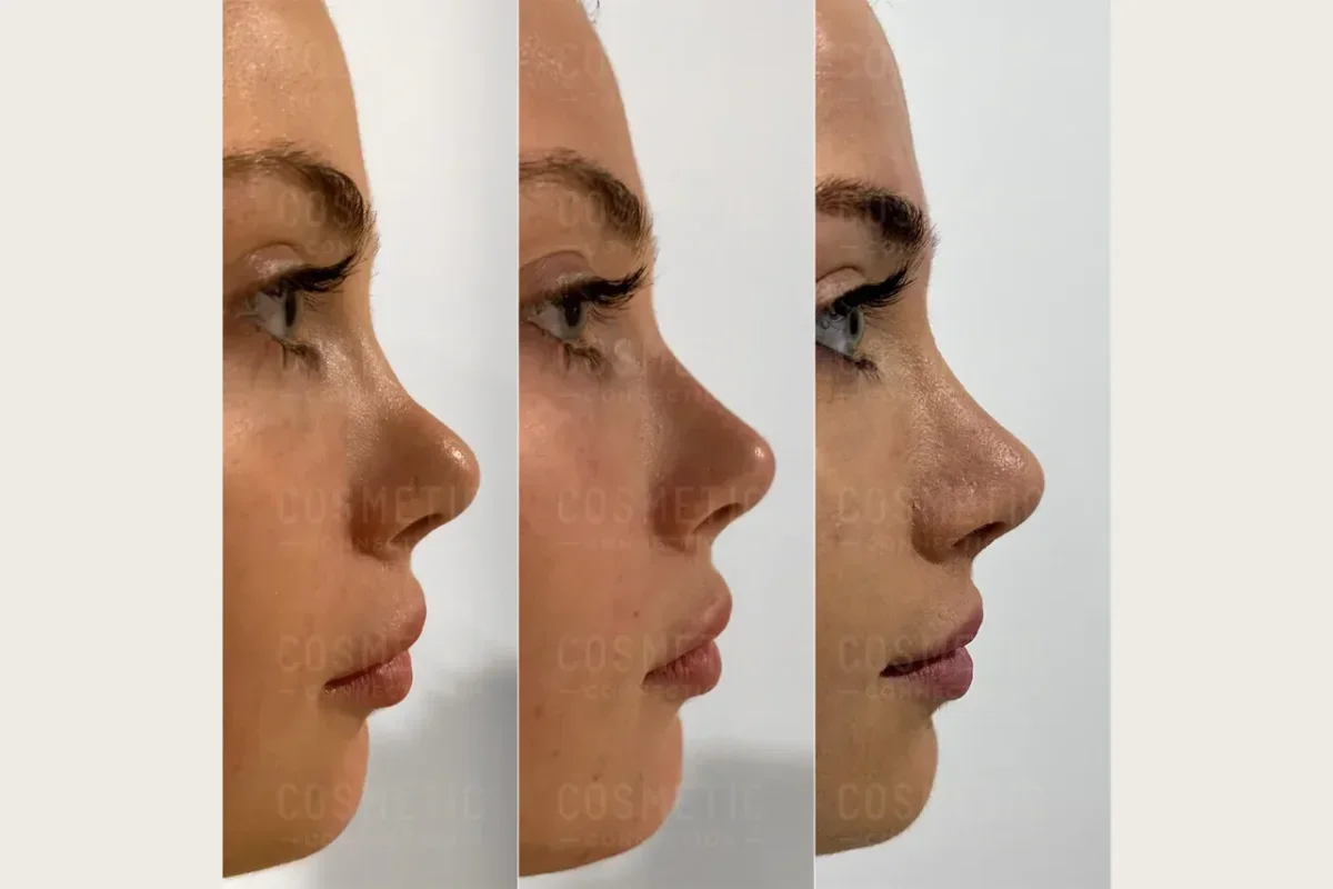 فیلر بینی و نکات ایمنی آن